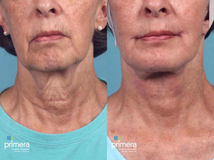 Before & After Chin & Cheek Implant Case 371 view-2 View in Orlando, Florida