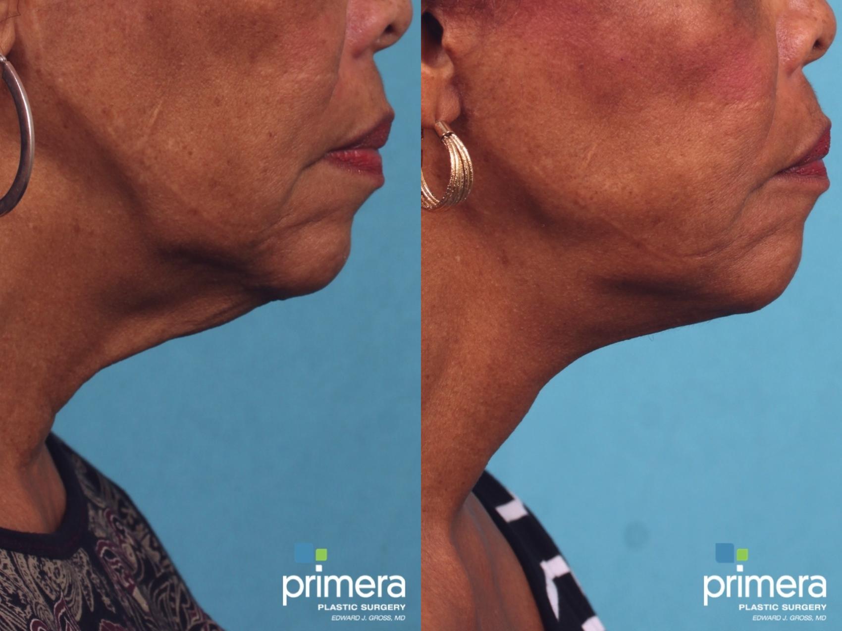 Before & After Mini Facelift Case 382 view-1 View in Orlando, Winter Park & Tampa, Florida