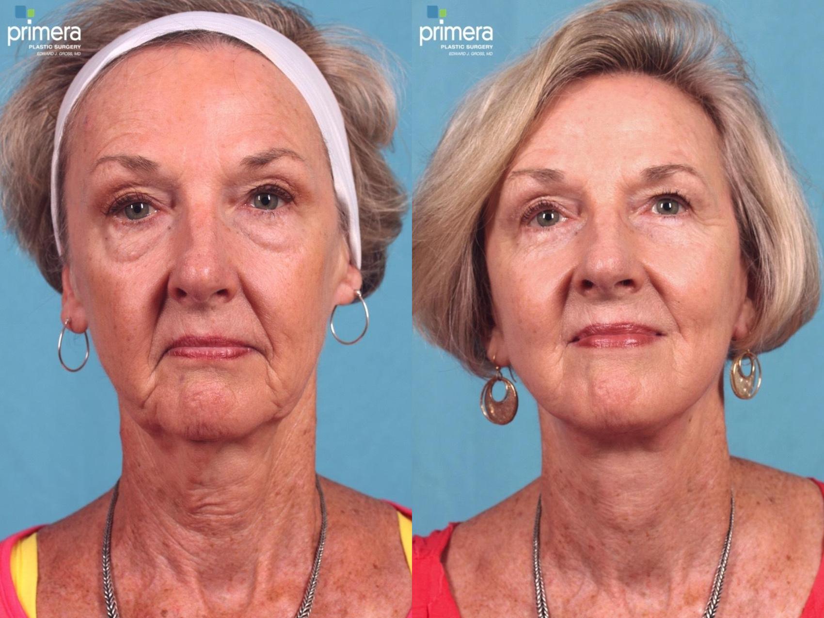 Before & After Facelift Case 400 view-1 View in Orlando, Florida