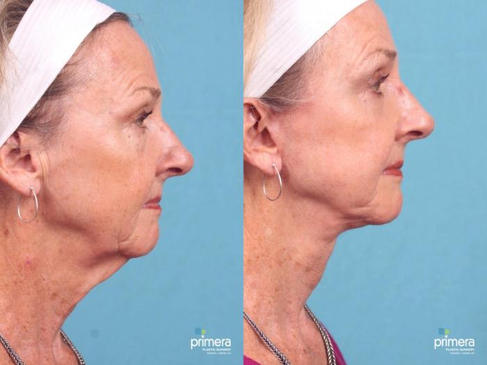 Before & After Facelift Case 400 view-2 View in Orlando, Florida