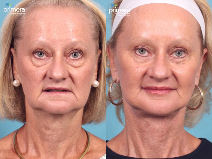 Before & After Blepharoplasty Case 415 view-1 View in Orlando, Florida