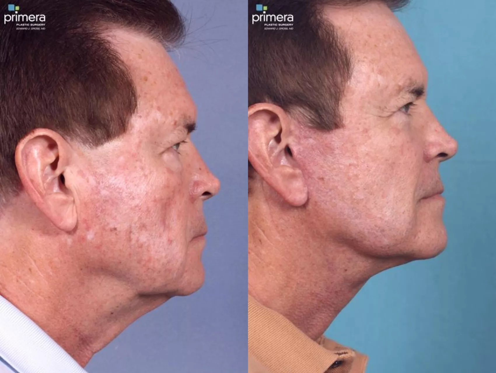 Facelift Before and After Pictures Case 444 | Orlando, Winter Park