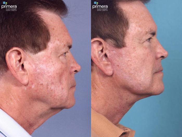 Before & After Surgery for Men Case 444 view-1 View in Orlando, Florida