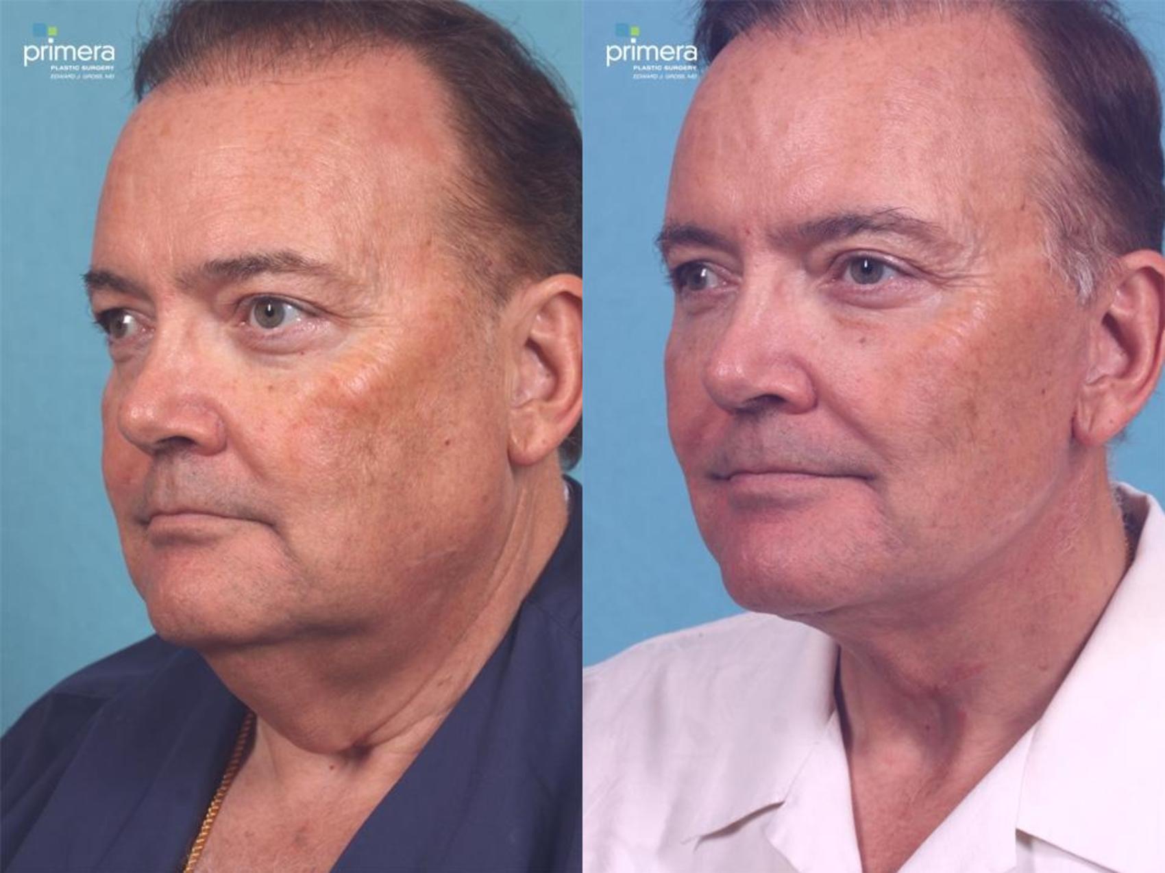 Before & After Facelift Case 446 view-2 View in Orlando, Florida
