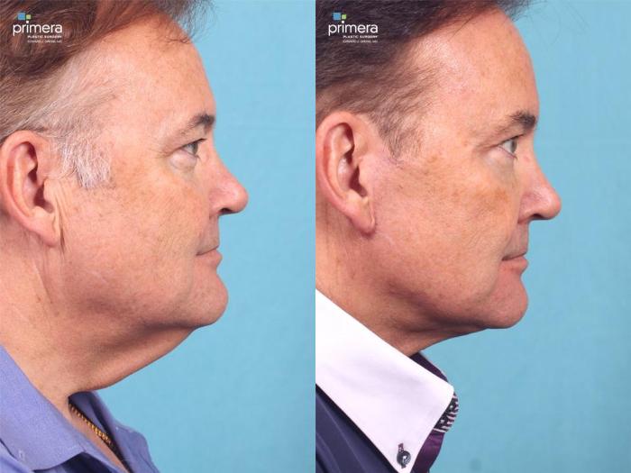 Before & After Surgery for Men Case 446 view-3 View in Orlando, Florida