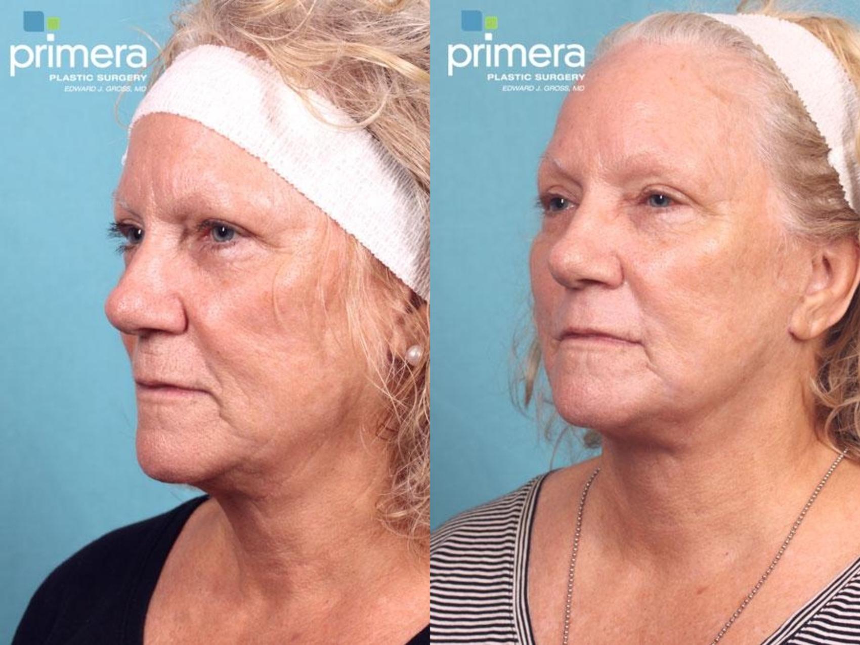 Before & After Chemical Peel Case 521 view-1 View in Orlando, Winter Park & Tampa, Florida