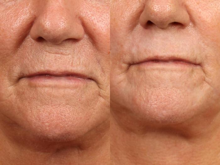 Before & After Chemical Peel Case 521 view-2 View in Orlando, Florida