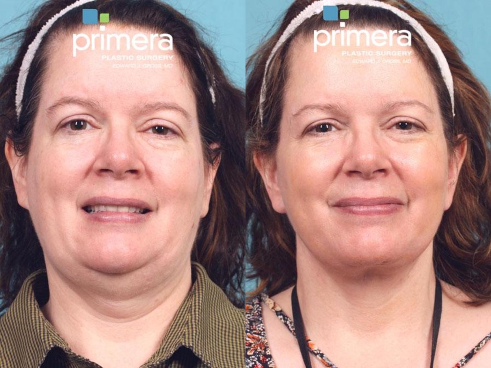 Before & After Facelift Case 572 view-1 View in Orlando, Florida