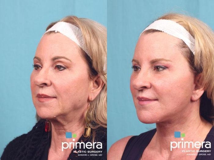 Before & After Facelift Case 573 view-1 View in Orlando, Florida