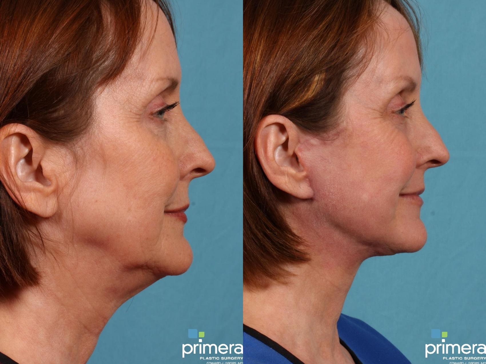 Before & After Facelift Case 58 view-1 View in Orlando, Florida