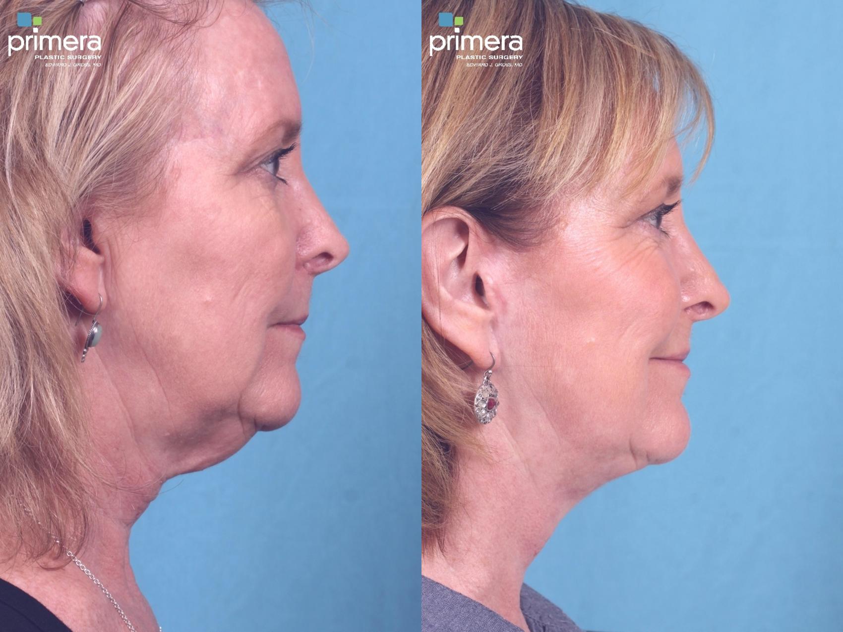 Mini Facelift Before After Photo Gallery Orlando Florida Primera Plastic Surgery