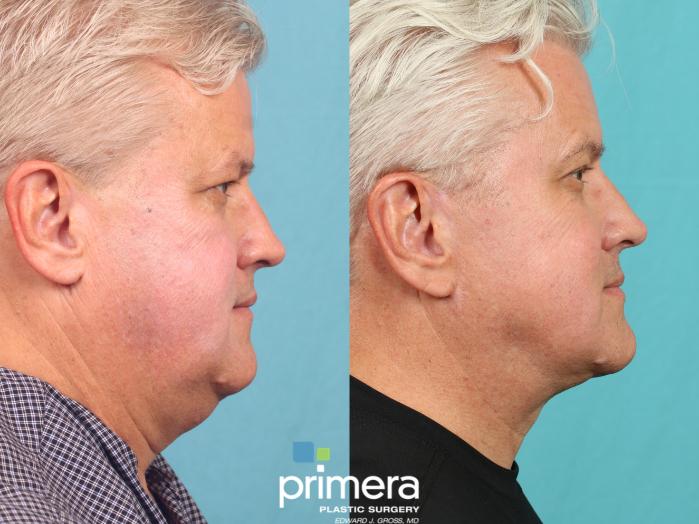 Before & After Neck Lift Case 653 Right Side View in Orlando, Florida