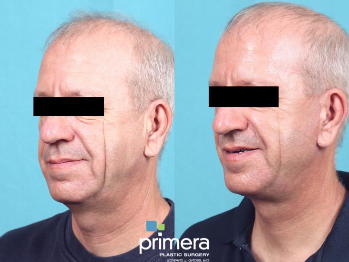 Before & After Facelift Case 669 Left Oblique View in Orlando, Florida