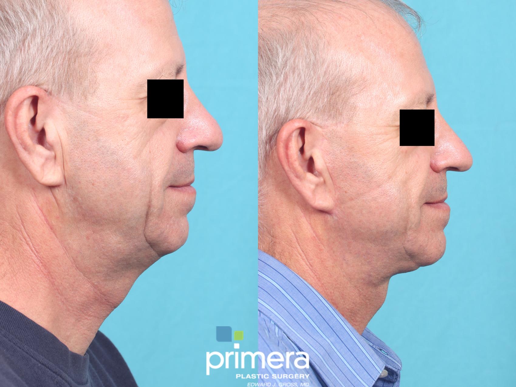 Before & After Neck Lift Case 669 Right Side View in Orlando, Florida