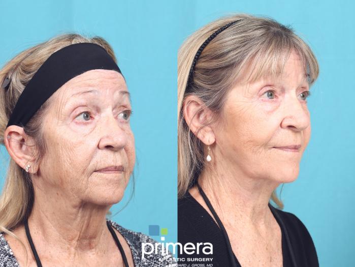 Before & After Neck Lift Case 709 Right Oblique View in Orlando, Florida