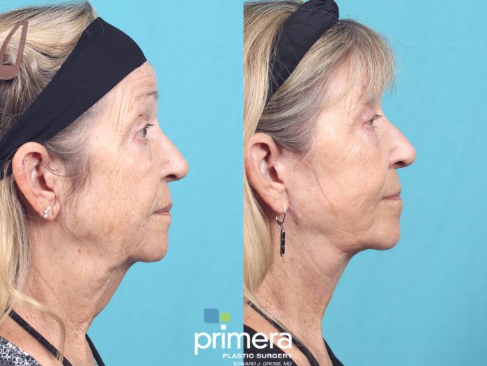 Before & After Laser Skin Resurfacing (DOT CO2) Case 709 Right Side View in Orlando, Florida