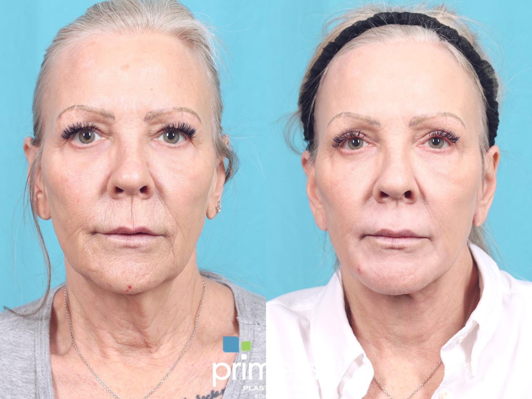 Before & After Blepharoplasty Case 750 Front View in Orlando, Florida