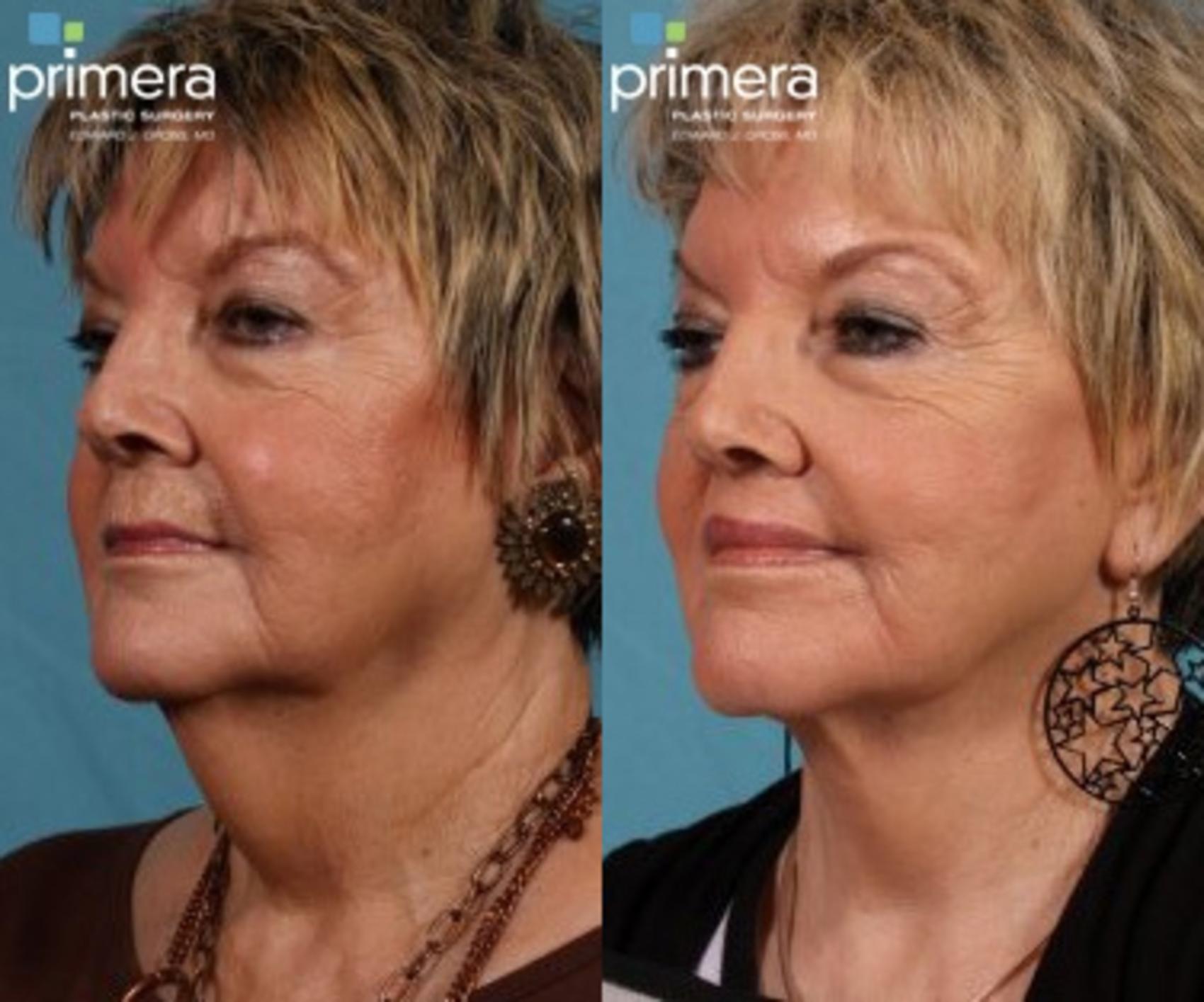 Before & After Neck & Face Liposuction Case 77 view-1 View in Orlando, Florida