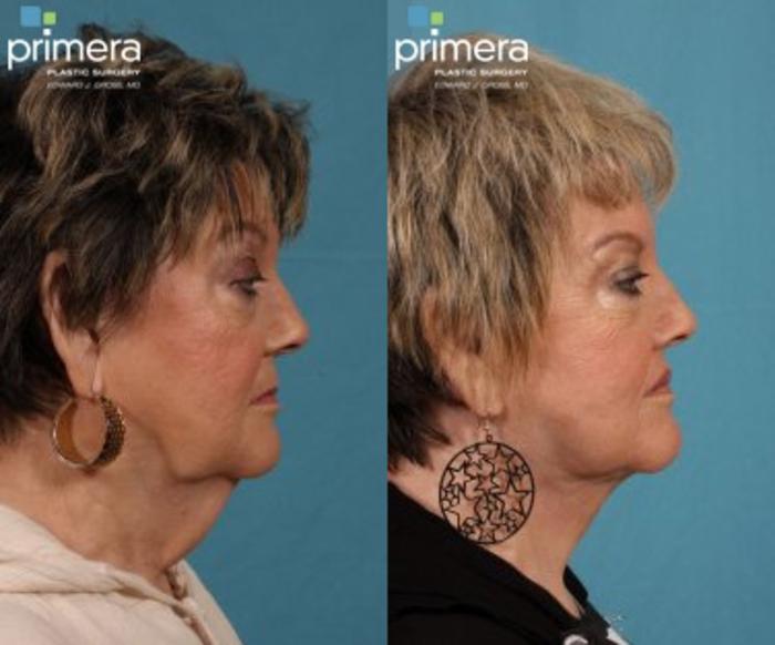 Before & After Facelift Case 77 view-2 View in Orlando, Florida