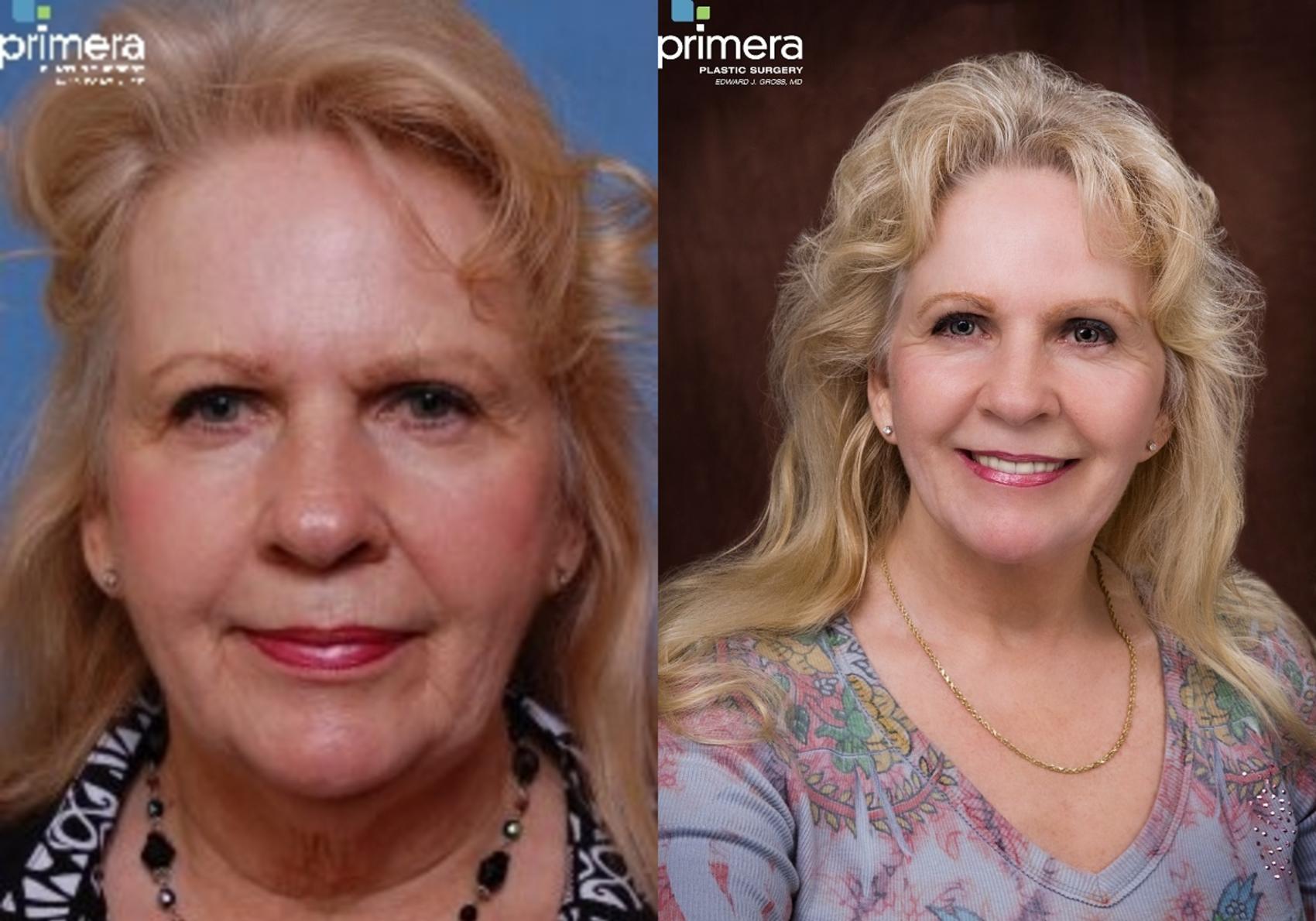 Facelift Before And After Pictures Case 98 Orlando Florida Primera Plastic Surgery 7592