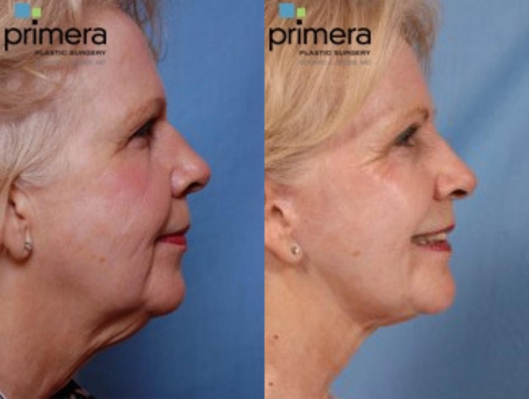 Before & After Brow Lift Case 98 view-3 View in Orlando, Florida