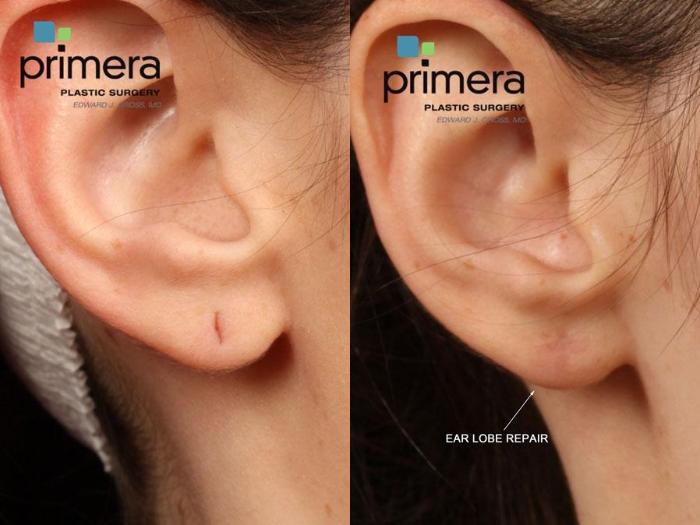 Before & After Ear Surgery (Otoplasty) Case 479 view-1 View in Orlando, Florida