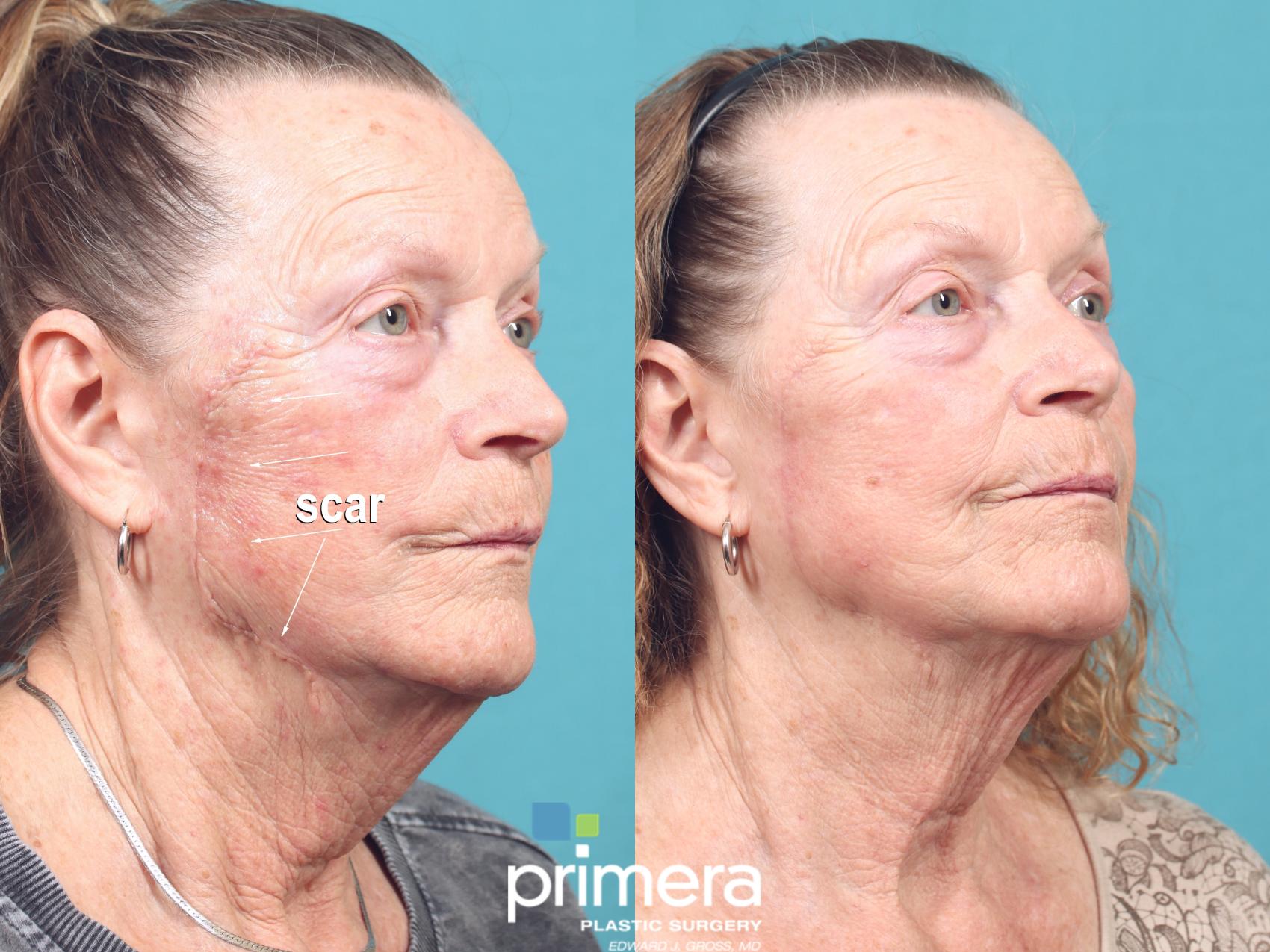 Before & After Facial Scarring Case 974 Right Oblique View in Orlando, Florida