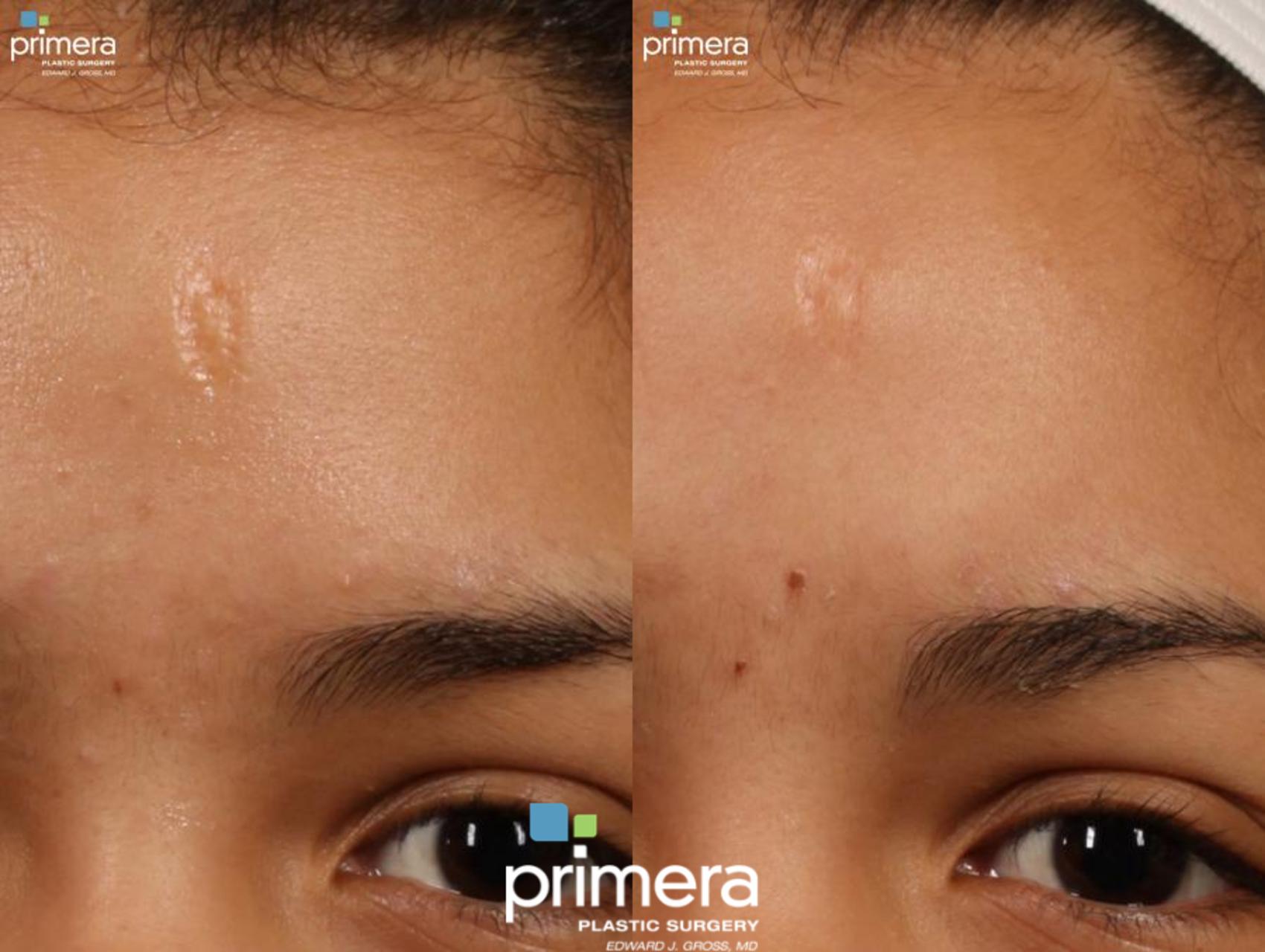 Fraxel laser | forehead scar | Orlando Florida