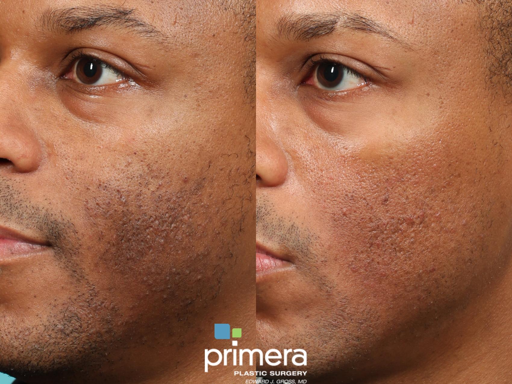 Fraxel® Laser Before and After Pictures Case 619 Orlando, Florida