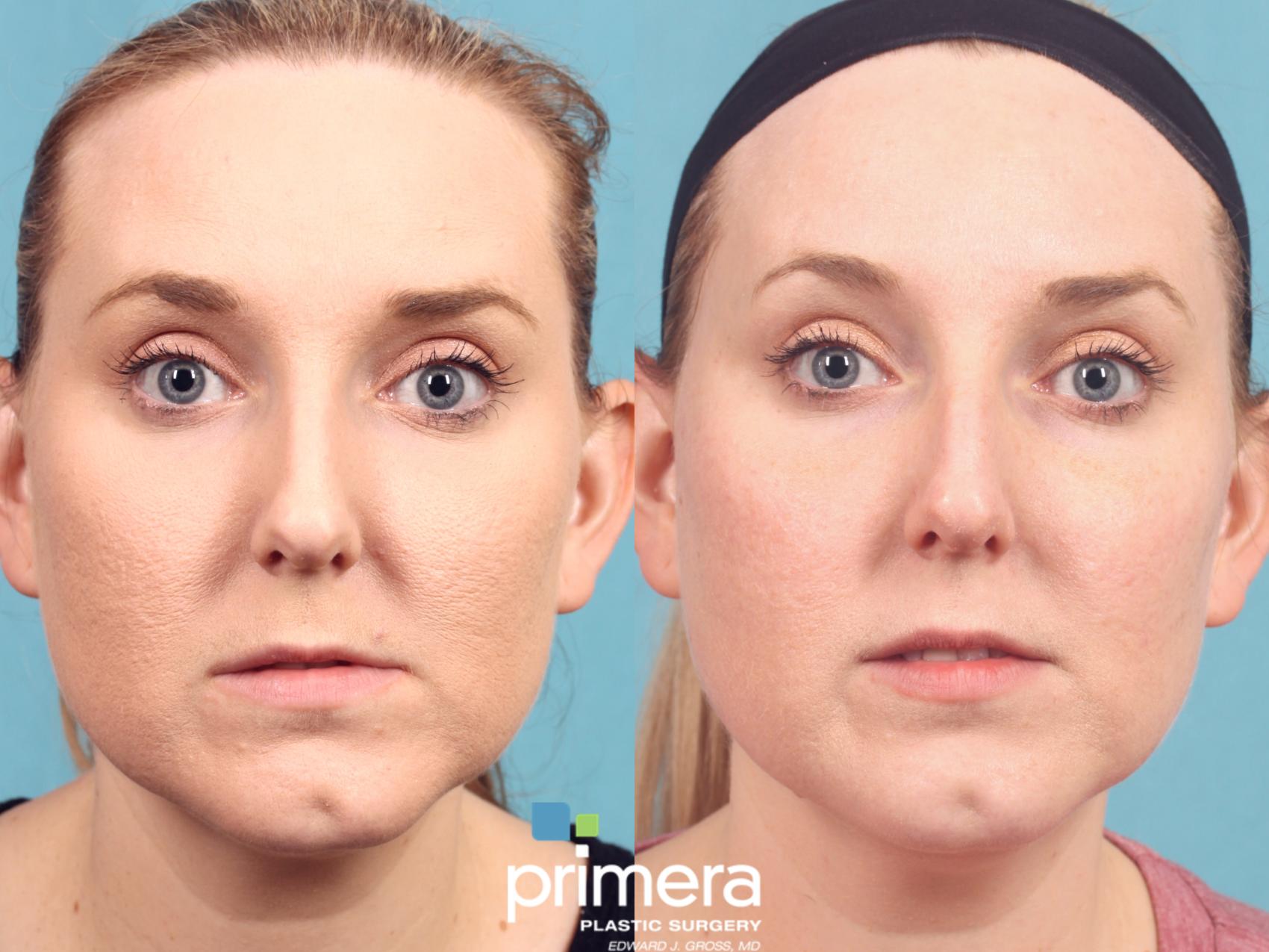 Fraxel Laser Before And After Pictures Case Orlando Florida Primera Plastic Surgery