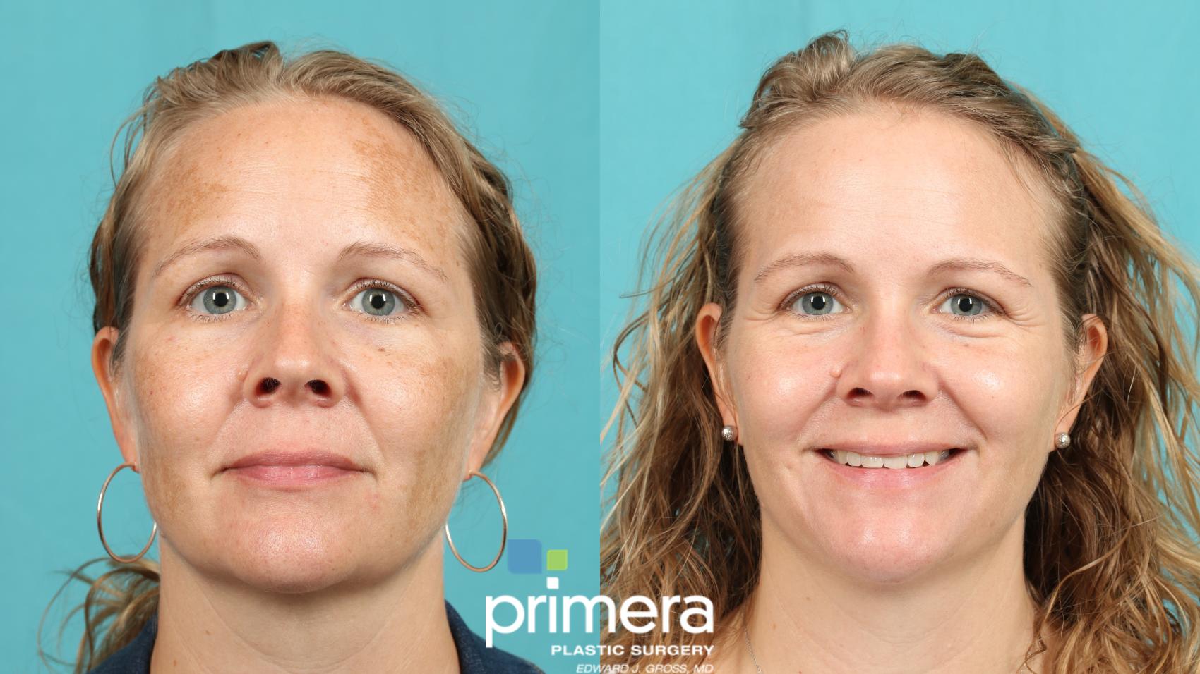 Fraxel | Before and After | Primera Plastic Surgery | Orlando, FL