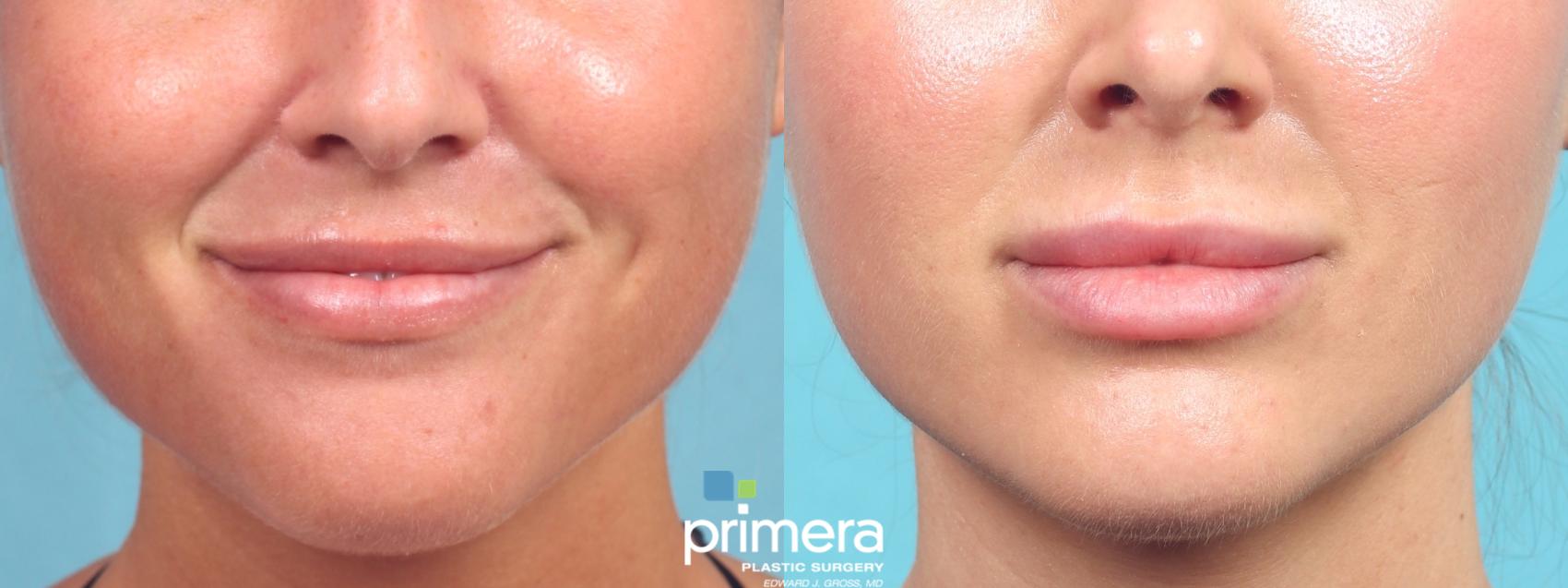 Before & After Injectables Case 1038 Front View in Orlando, Winter Park & Tampa, Florida