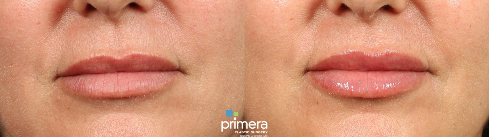 Lip Filler | Juvederm Volbella | Primera Plastic Surgery | Orlando, FL