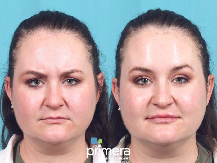 Botox | Volbella | Primera Plastic Surgery | Orlando, FL