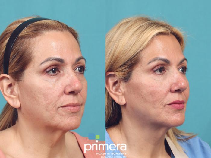 Before & After Injectables Case 1033 Right Oblique View in Orlando, Winter Park & Tampa, Florida