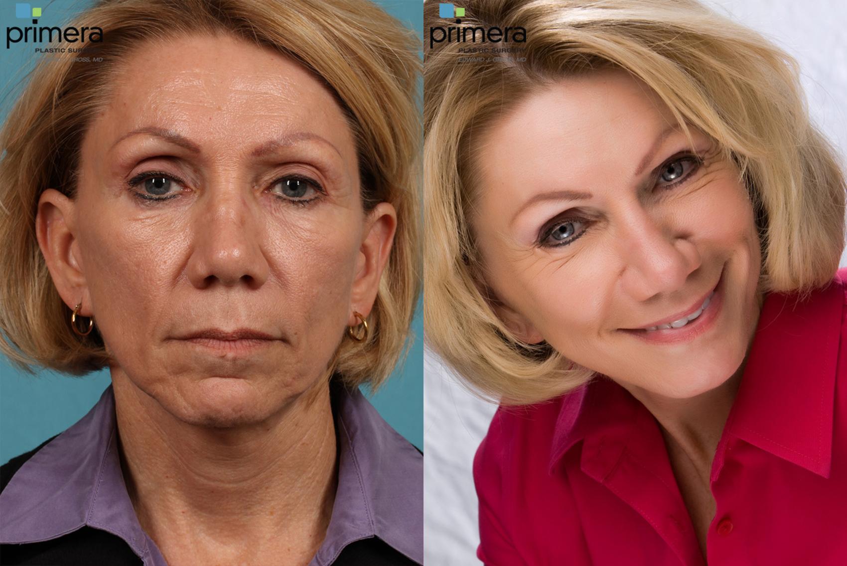 Mini Facelift Before After Photo Gallery Orlando Florida Primera Plastic Surgery