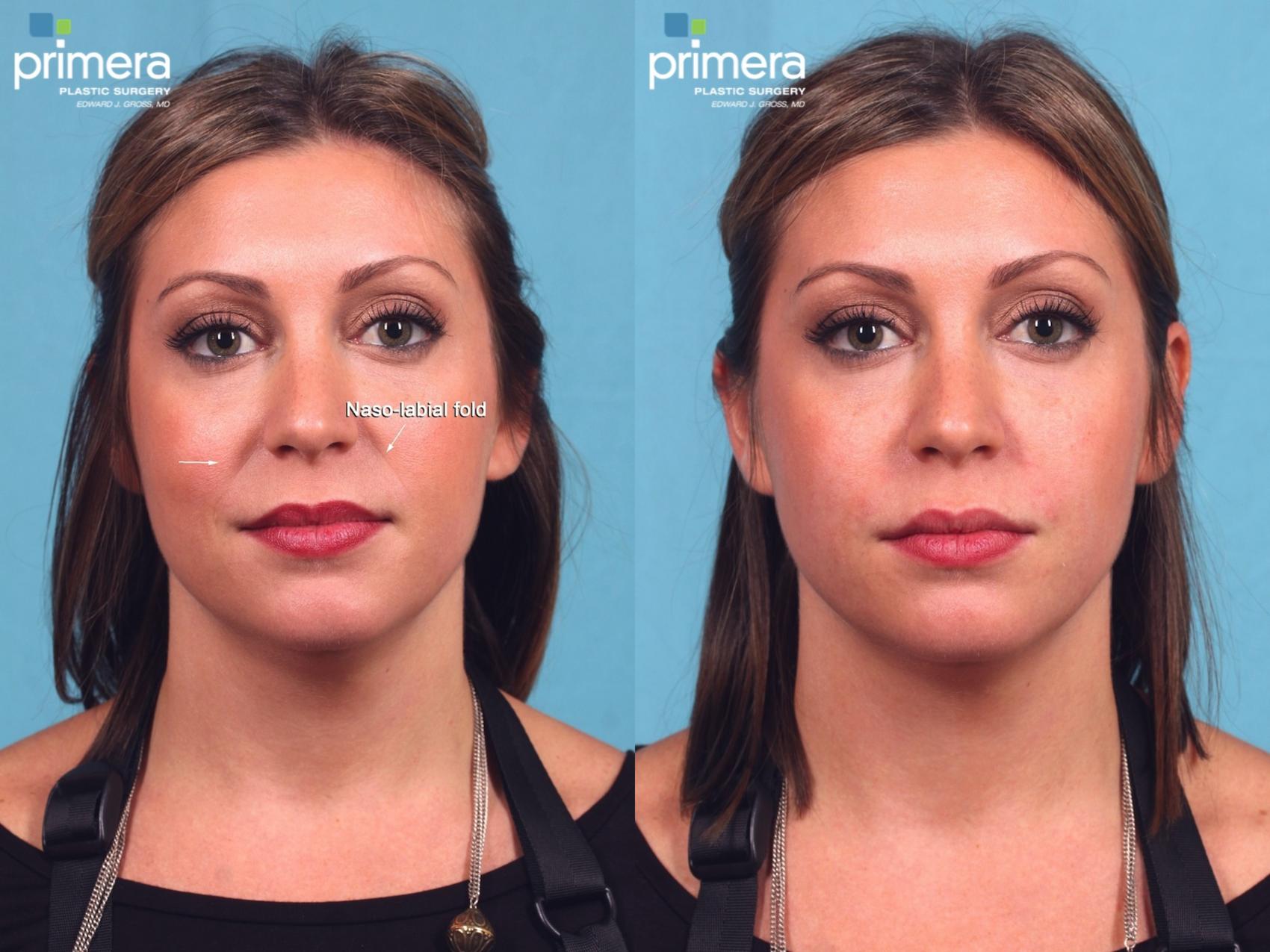 The Definitive Guide to The Basics Of The Injectable Filler Juvéderm Voluma Xc thumbnail