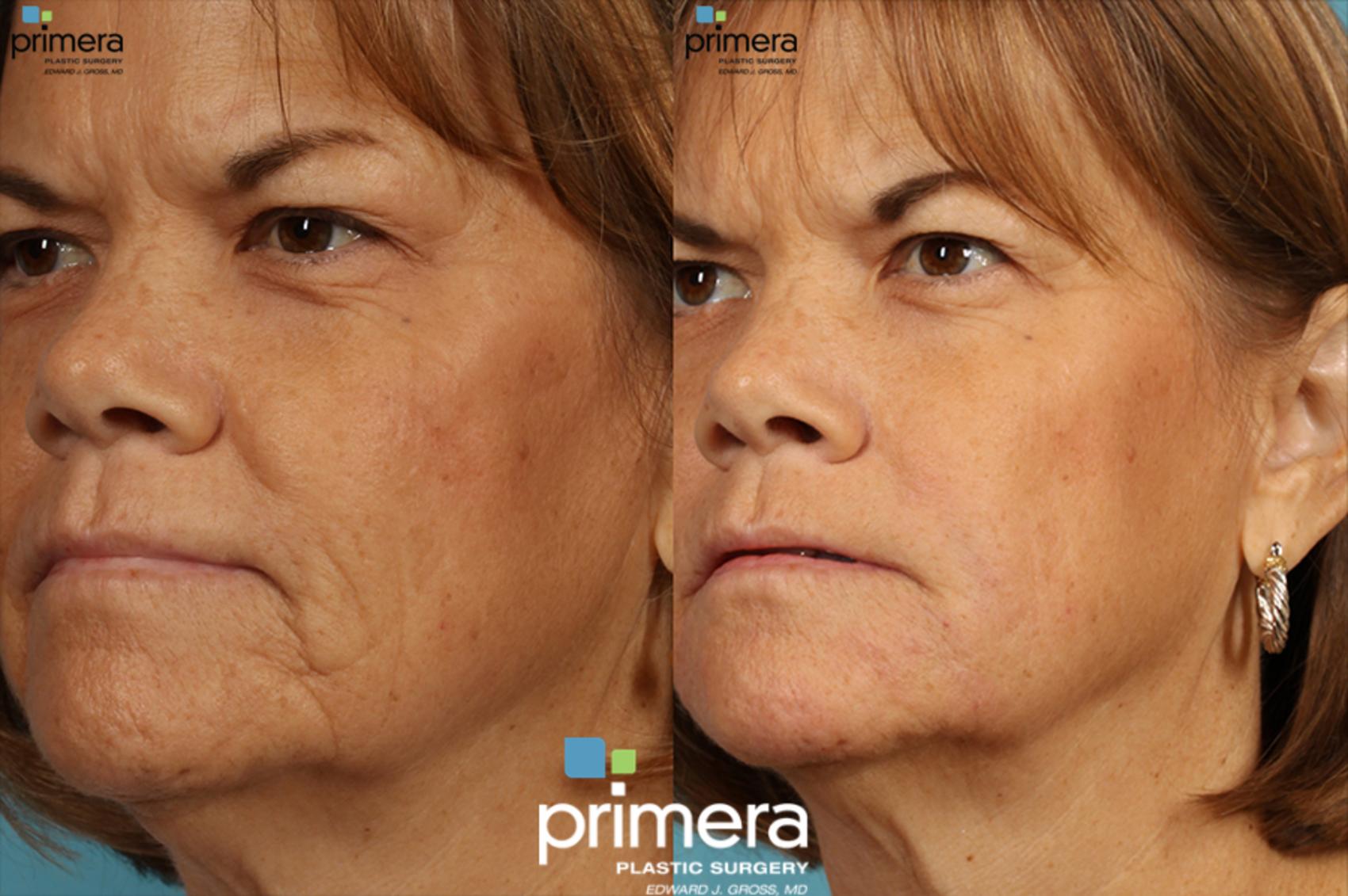 438- Juvederm for Mouth Lines