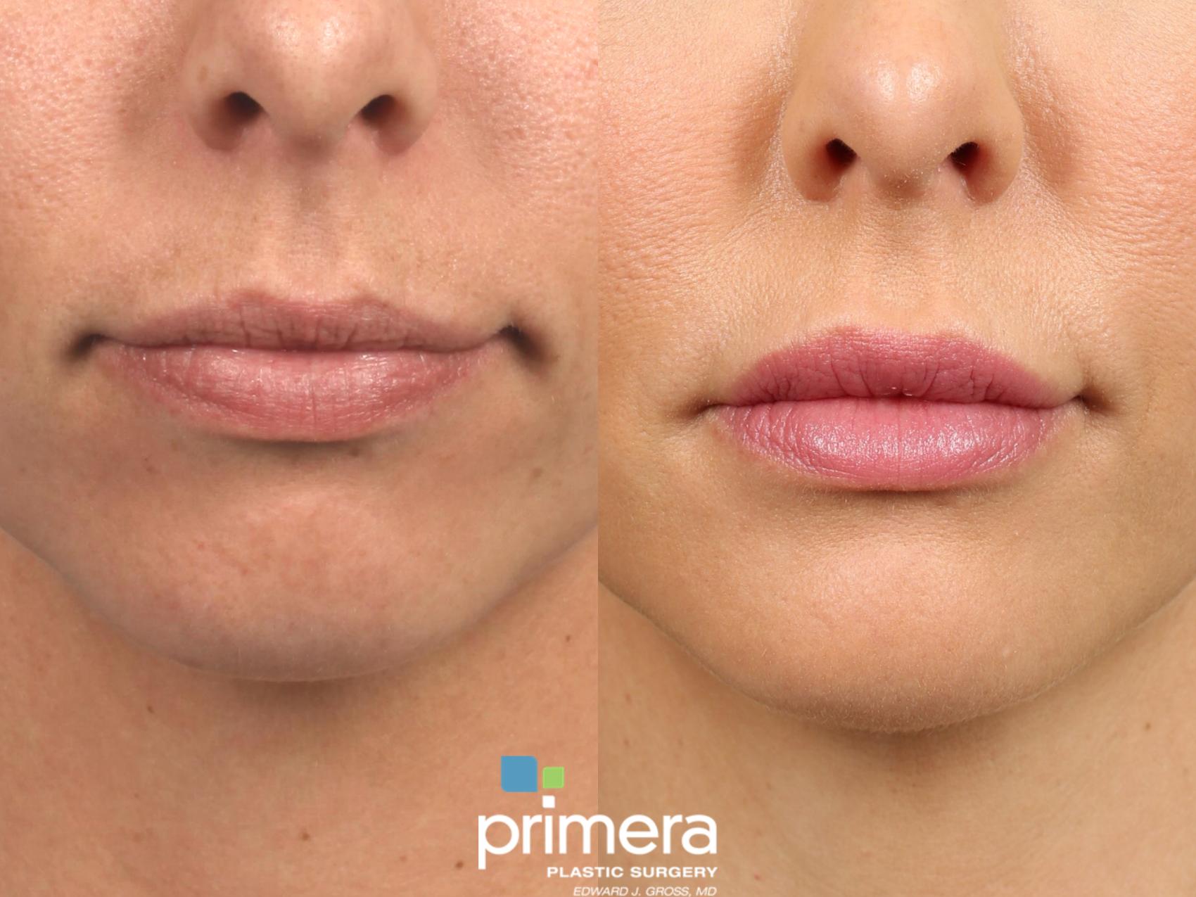 3 Easy Facts About Juvéderm® Lip Filler - Juvederm Injections - Clark Institute For ... Shown thumbnail