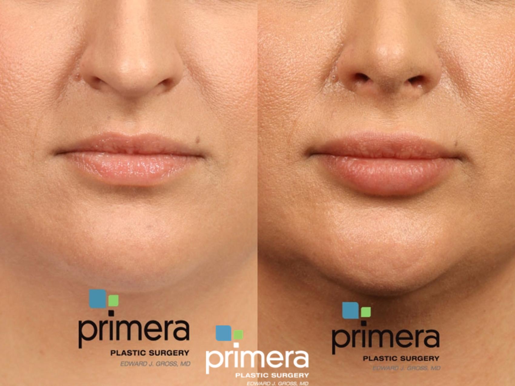 Lip Filler Injections for Orlando & Winter Park, FL | Primera Plastic 