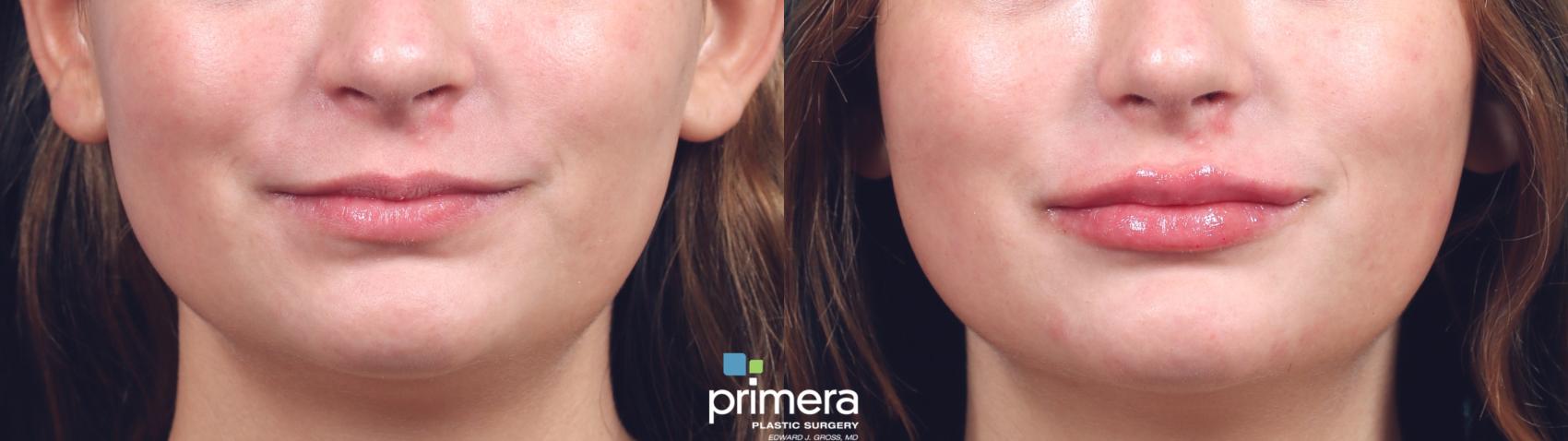 Juvederm Vollure | Lip Filler | Primera Plastic Surgery | Orlando, FL