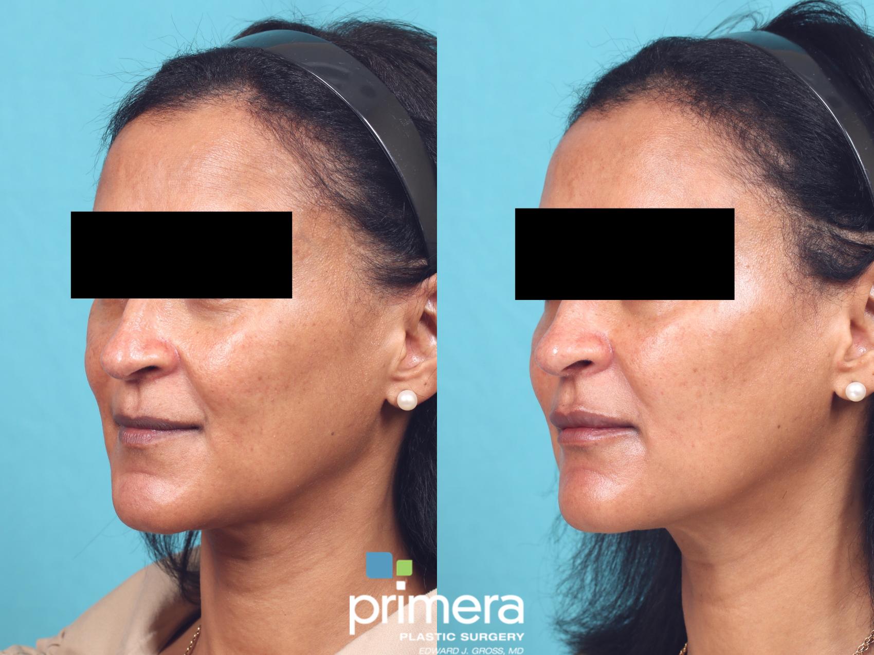 Before & After JUVÉDERM® Case 936 Left Oblique View in Orlando, Florida