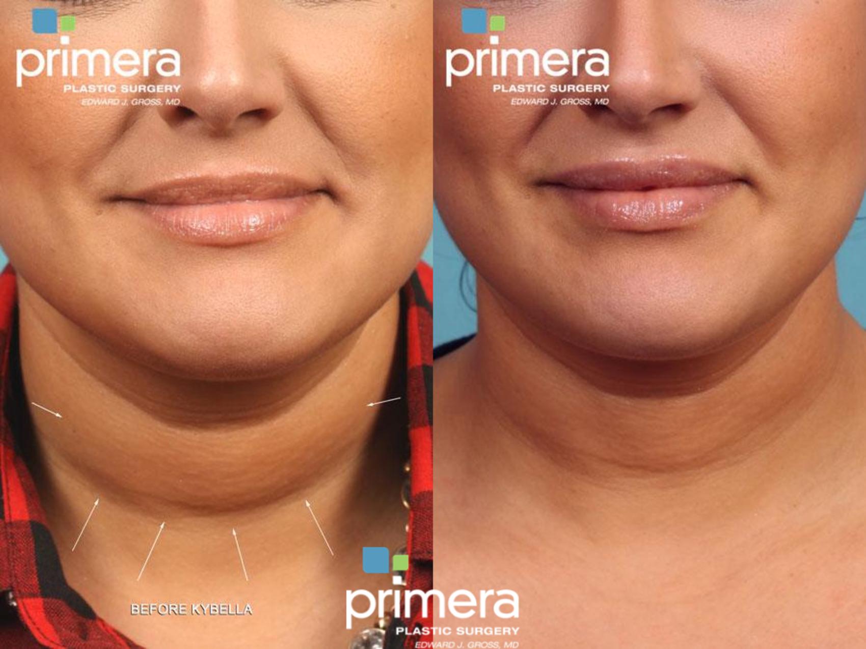 Kybella for a Chiseled Jawline, Utah Facial Plastics