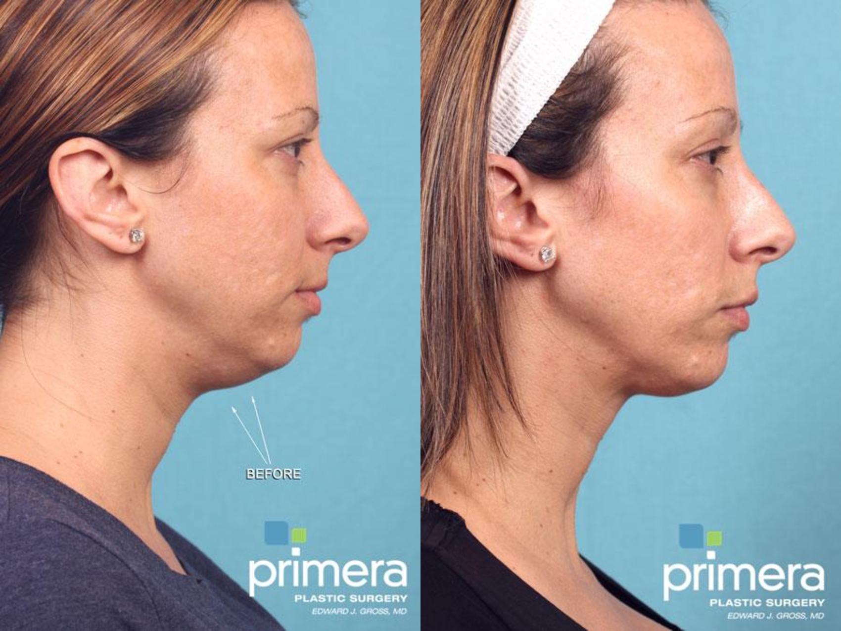 Kybella® Double Chin Treatment For Orlando And Winter Park Fl Primera Plastic Surgery