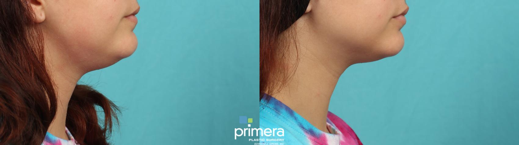 Kybella | Primera Plastic Surgery | Orlando, FL