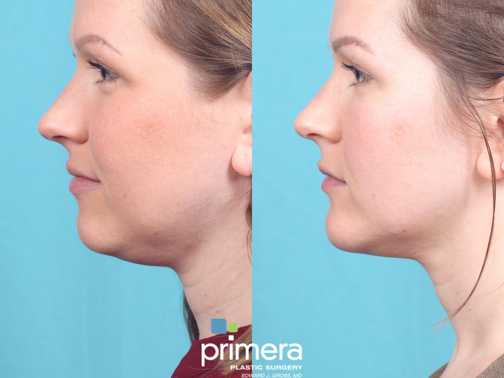 Kybella for a Chiseled Jawline, Utah Facial Plastics