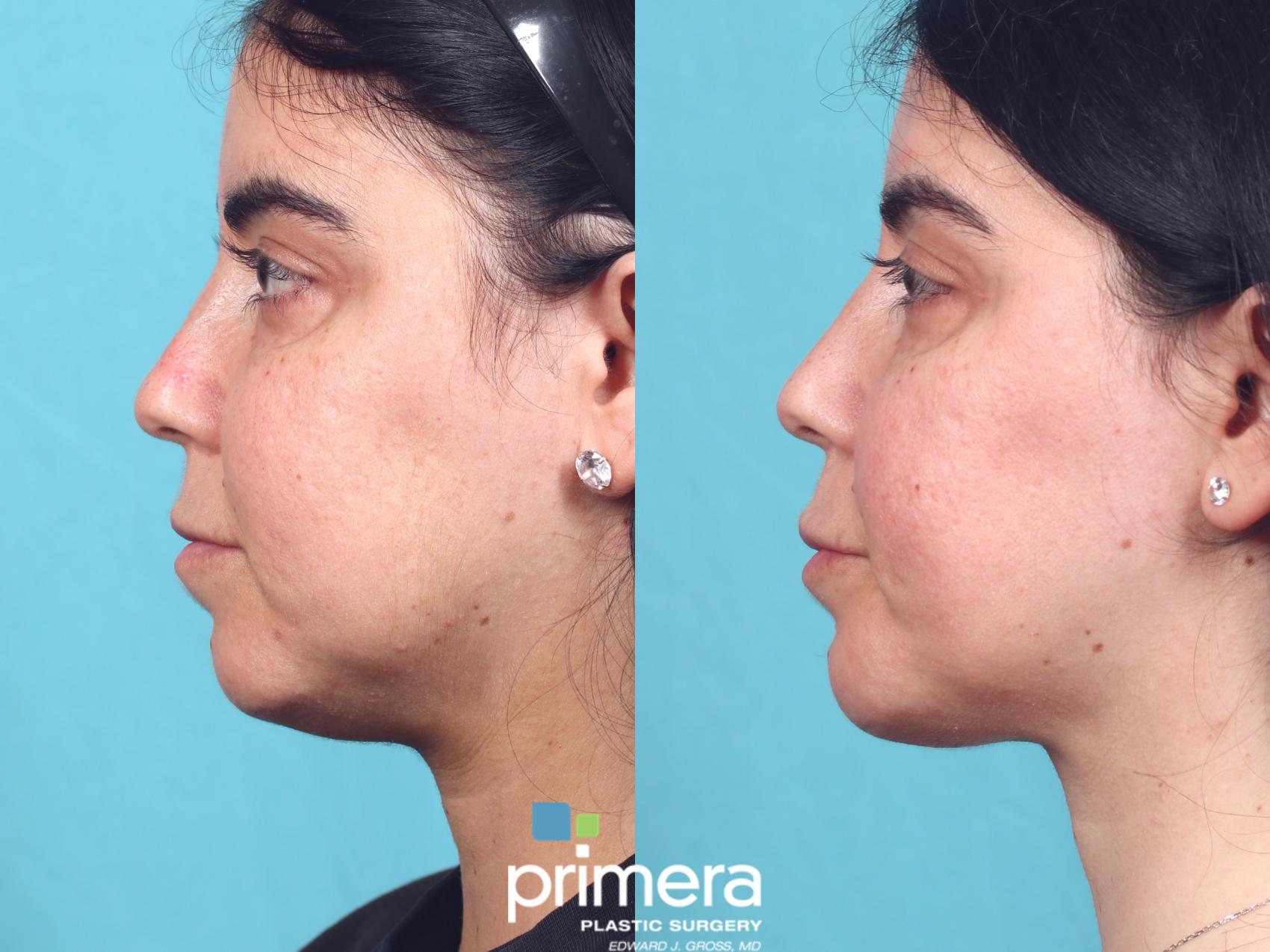 Kybella for a Chiseled Jawline, Utah Facial Plastics