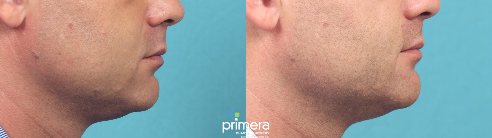 Before & After Buccal Fat Removal Case 981 Right Side View in Orlando, Florida