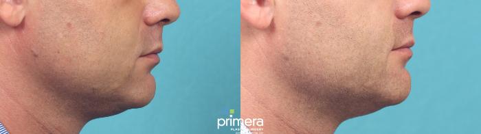 Before & After Kybella® Case 981 Right Side View in Orlando, Florida