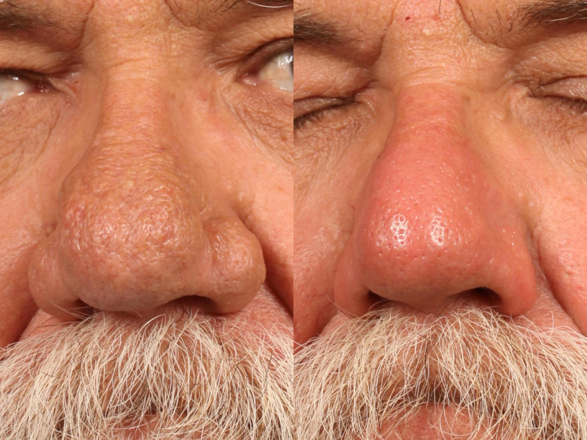 How Much Does Resurfacing Laser Treatment Cost